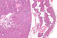 Parathyroid adenoma low mag.jpg