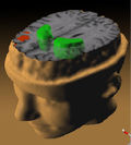 Данные позитронно-эмиссионной томографии мозга больного шизофренией