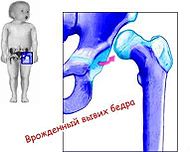 Congenital dislocation of the hip.jpg