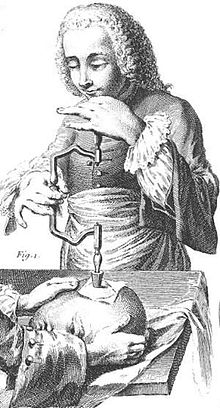 Trepanation illustration France 1800s.jpg